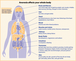 Anorexia