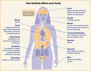 Factors Contributing to Bulimia